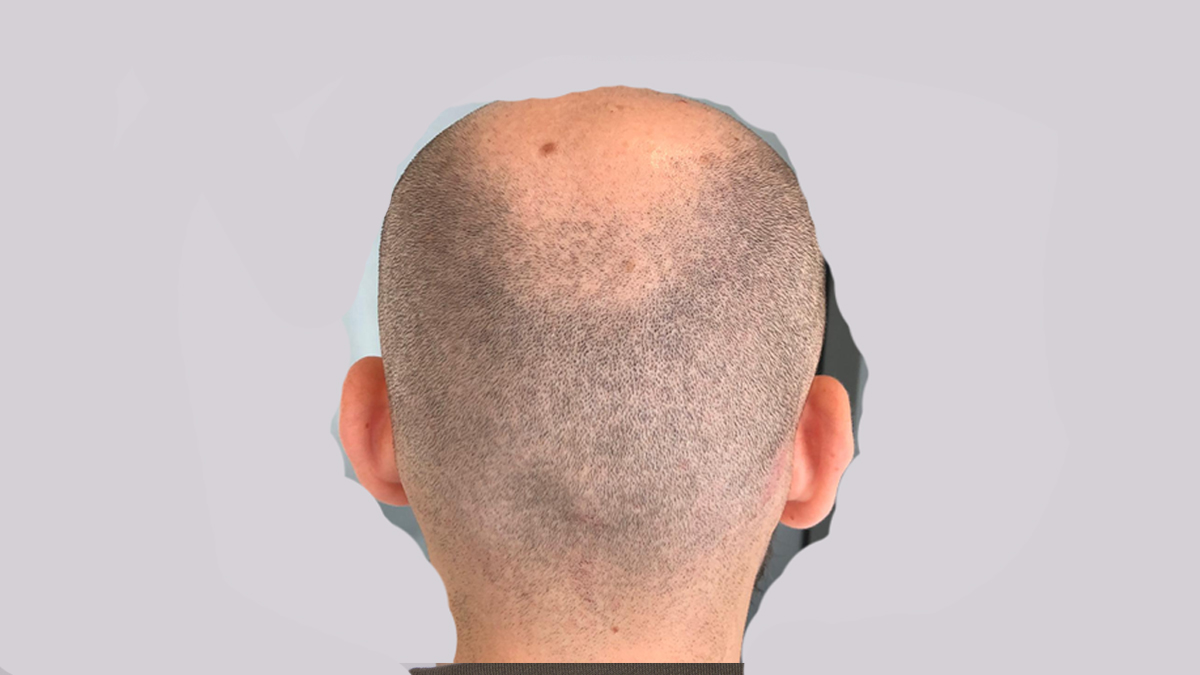 Przed zabiegiem